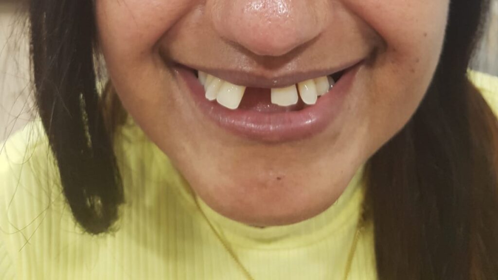 a person with missing teeth